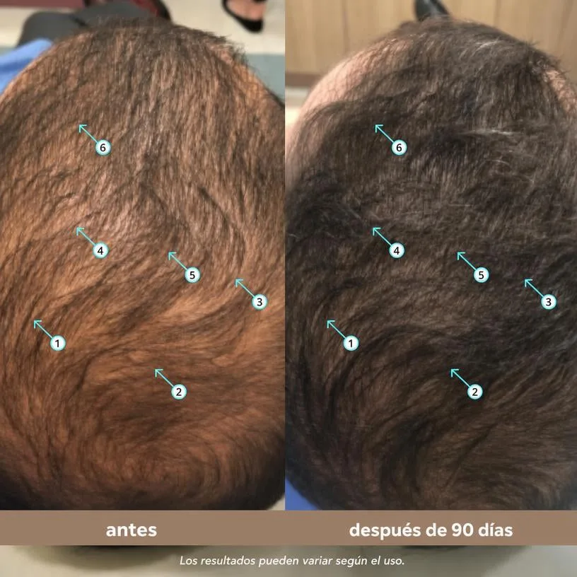 Sérum de Densidad Capilar para Hombre con Nanoxidil 5% — Anticaída 60 ml