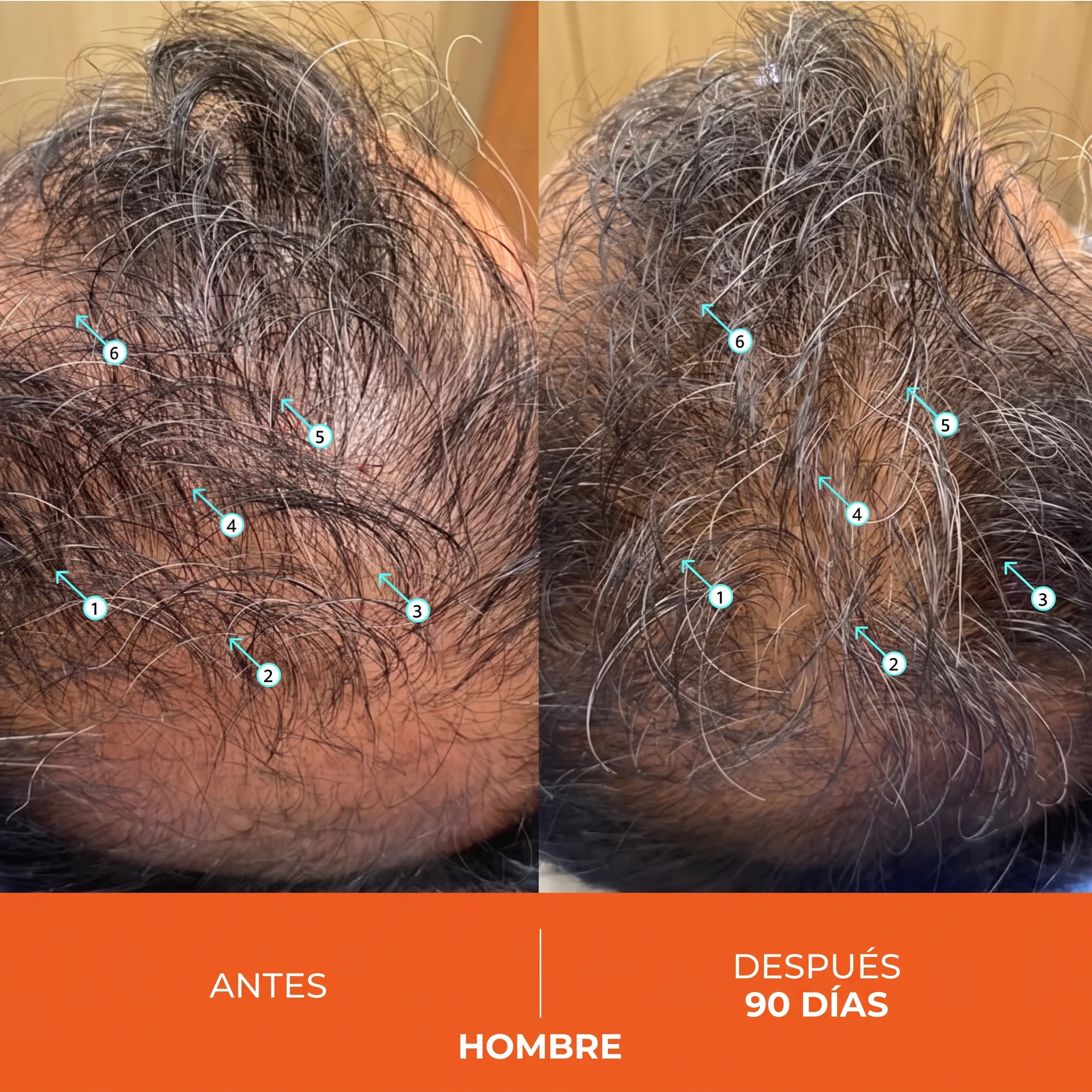 Antes y Después Hombre 90 Días 6 flechas